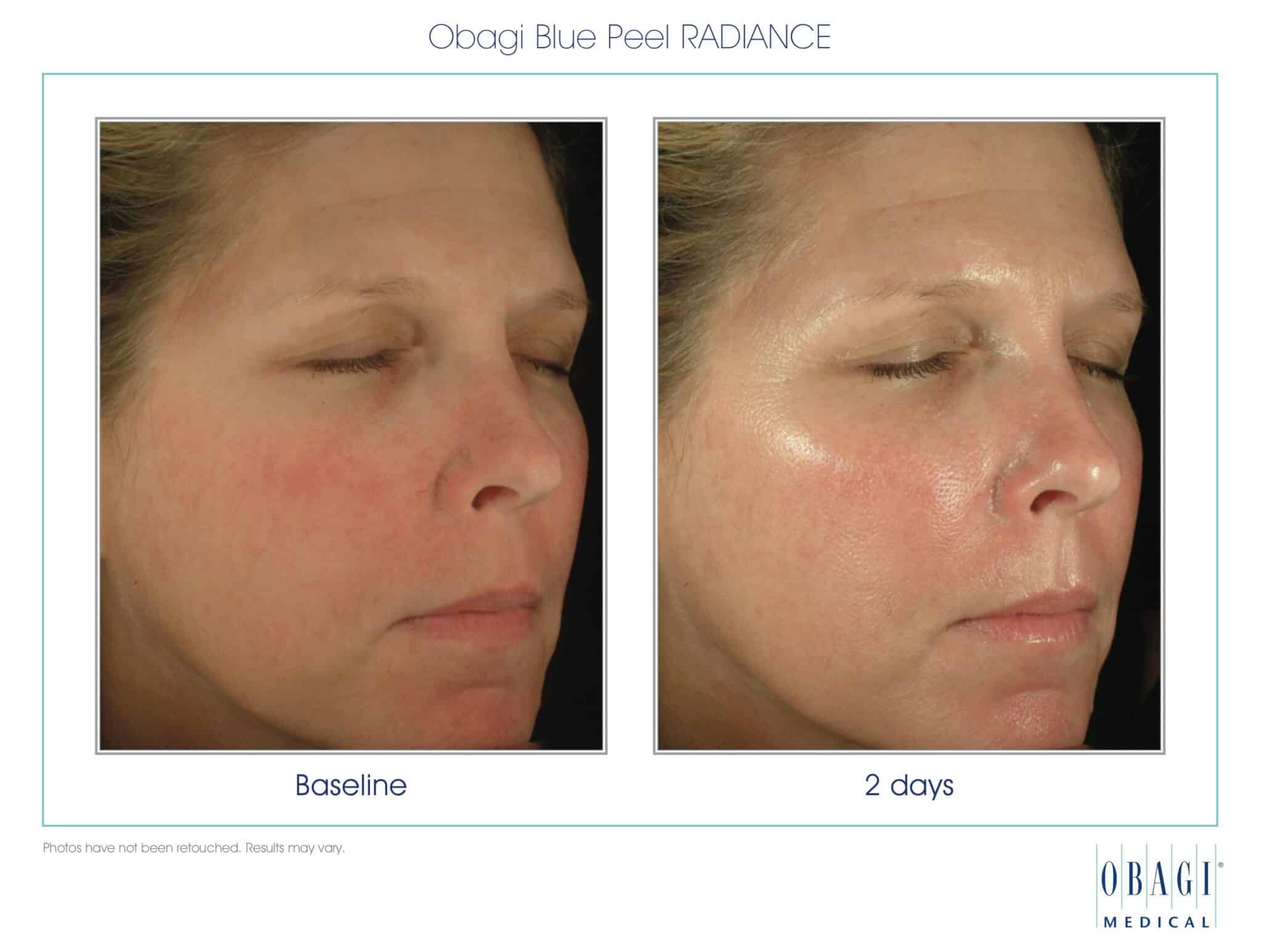 chemical peel