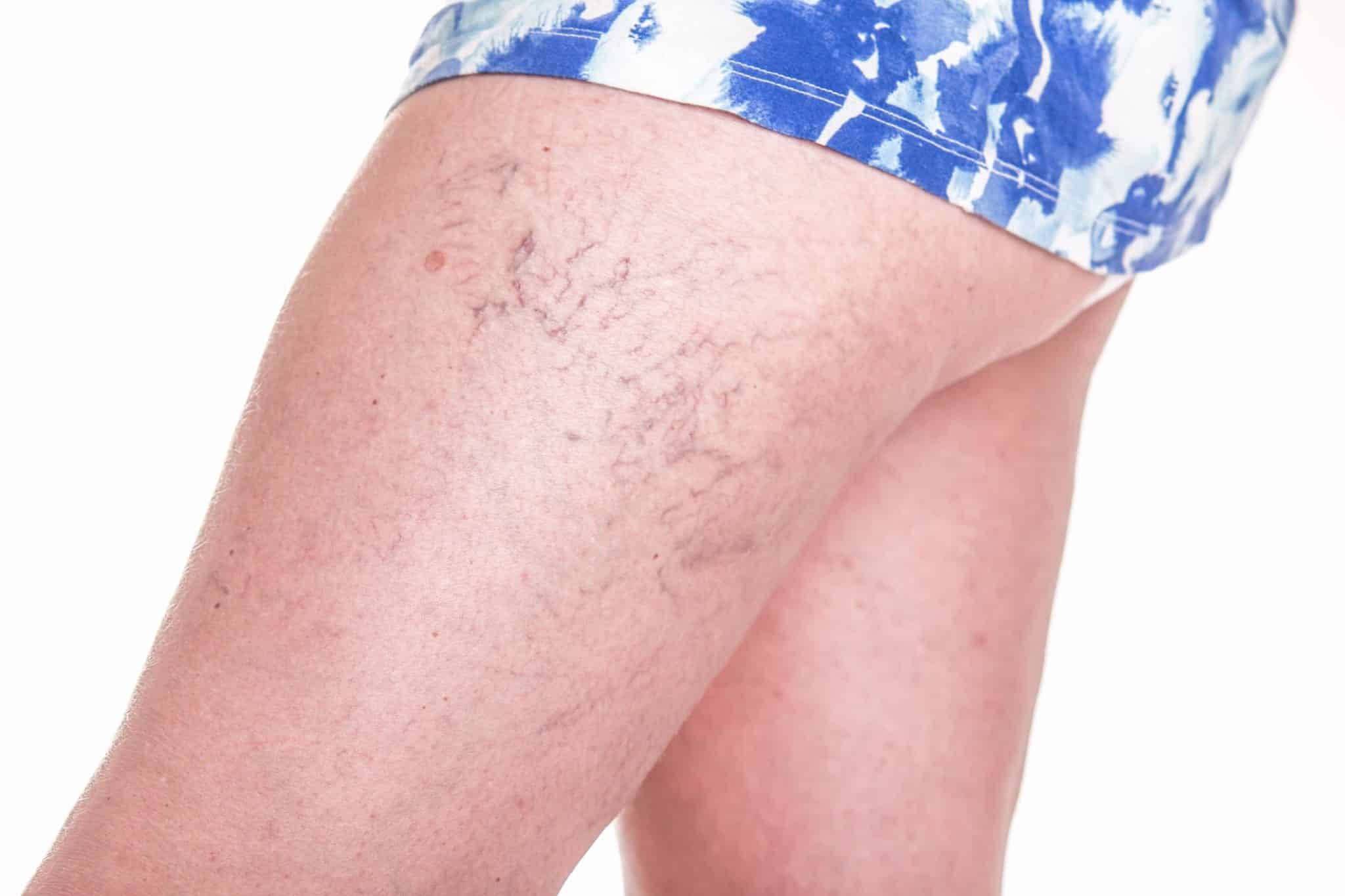 Spider Vein Treatment | Bend, OR