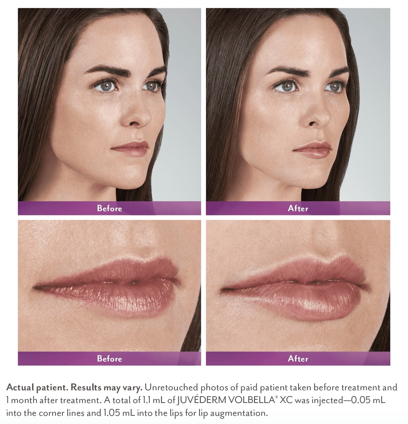 JUVÉDERM® Vobella XC Before & After Photos