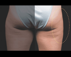 CoolSculpting® – Thighs