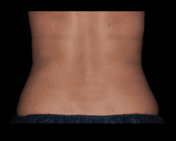 CoolSculpting® – Flanks