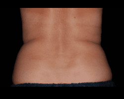 CoolSculpting® – Flanks