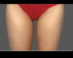 CoolSculpting® – Thighs