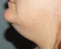 CoolSculpting® – Chin