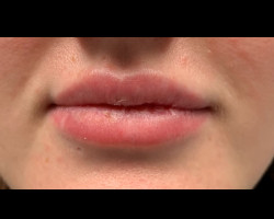 VERSA – Lip Injections