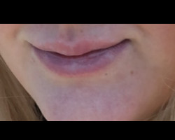 VERSA – Lip Injections