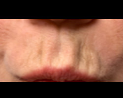 Botox for Lip Lines