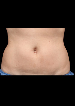 CoolSculpting® – Abs