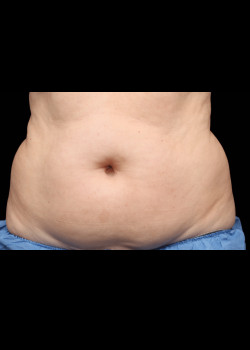 CoolSculpting® – Abs